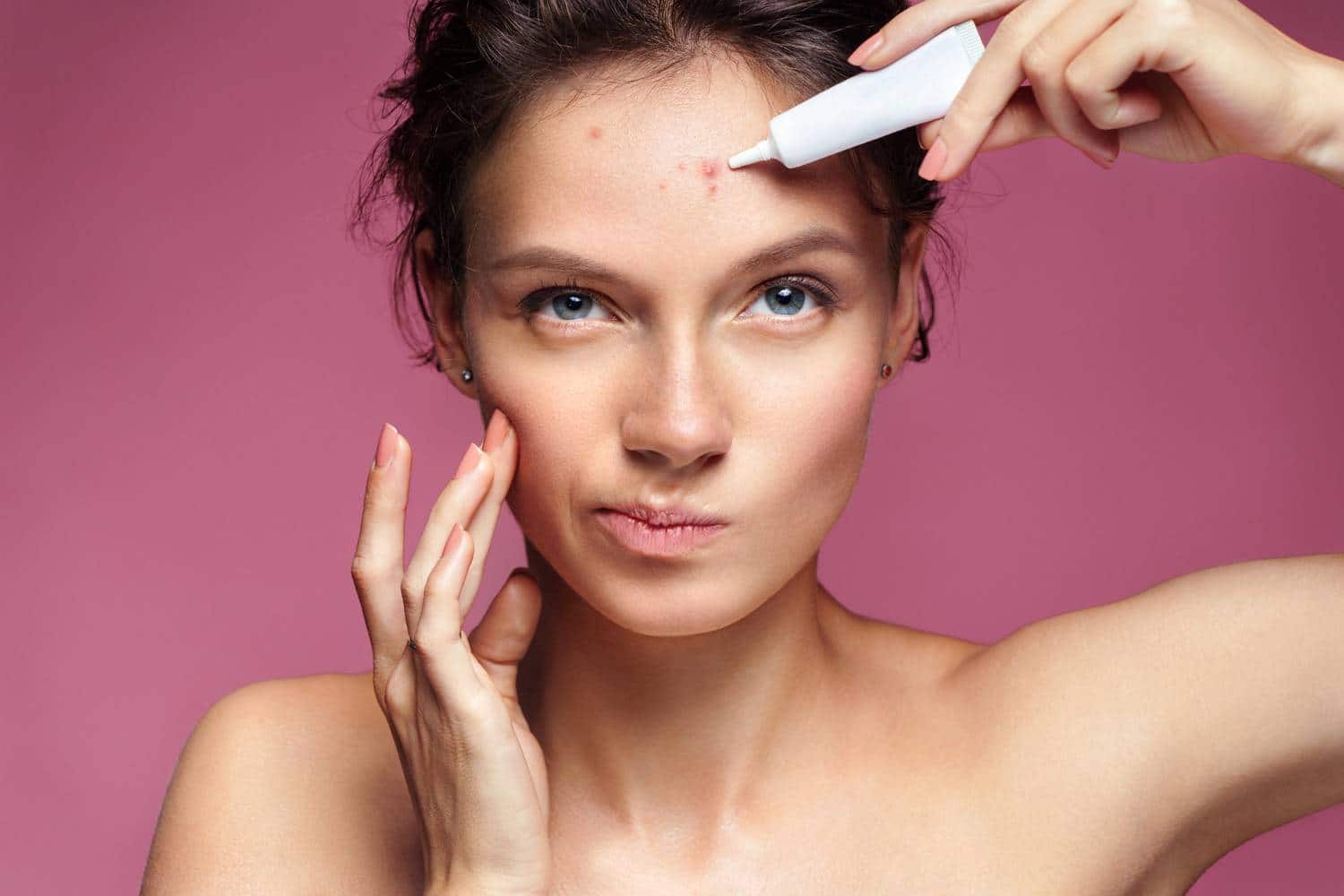 comment traiter acné adulte