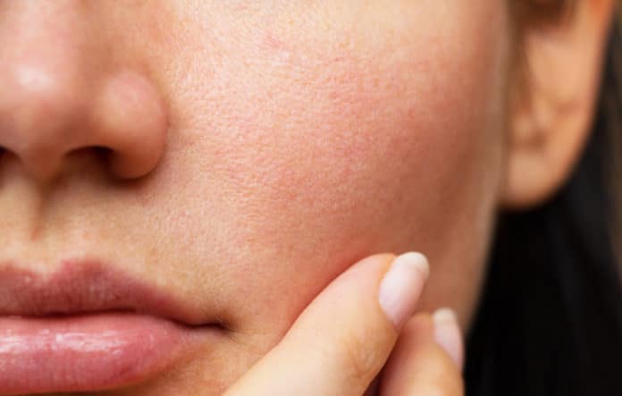 pores dilatés comment les resserrer